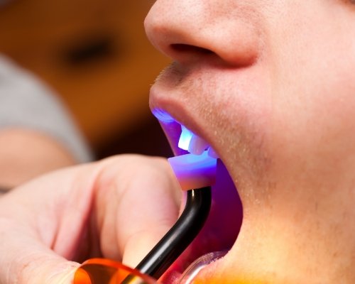 Close up of a patient receiving cosmetic dental bonding