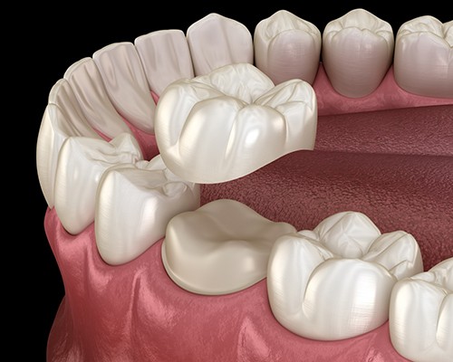 Illustration of dental crown being placed on tooth