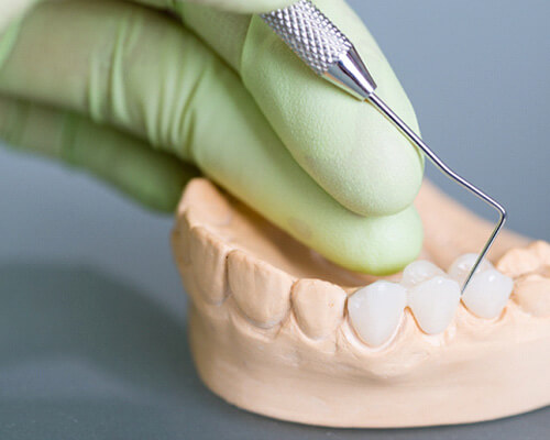 Dentist placing model dental bridge