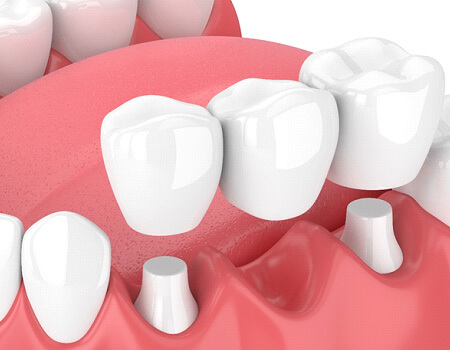 Illustration of traditional dental bridge over abutment teeth