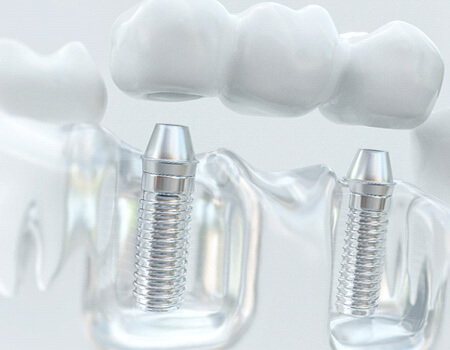 Transparent illustration of dental implant bridge
