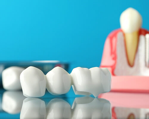 Example dental bridge with dental implant background