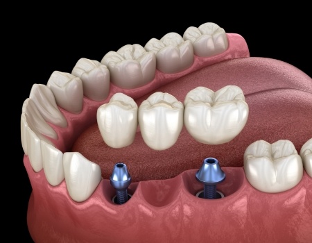 Animated dental bridge supported by two dental implants
