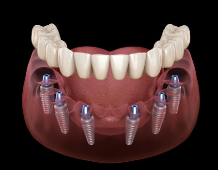 Animated implant denture supported by six dental implants