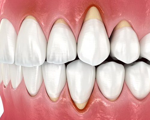 Illustration of receding gums