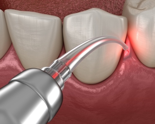 Animated soft tissue laser treating diseased gum tissue