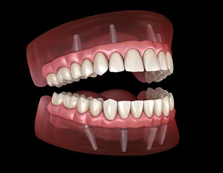 Illustration of fixed implant dentures?