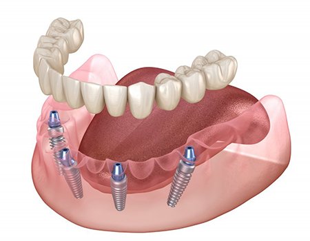 Illustration of removable dentures