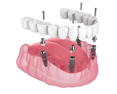 Illustration of fixed implant dentures?