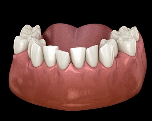 Illustration of crowded teeth