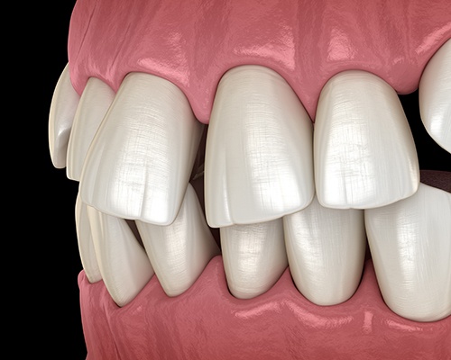 Illustration of gapped teeth