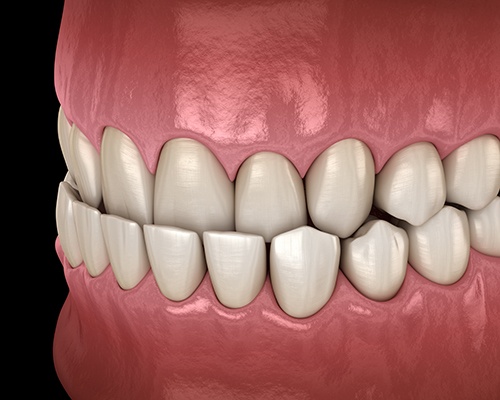Illustration of an underbite