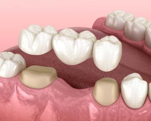 Animated dental bridge replacing a missing tooth in Jenks