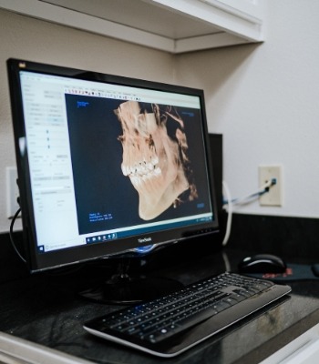 3 D digital image of a patient's jaw on a computer screen