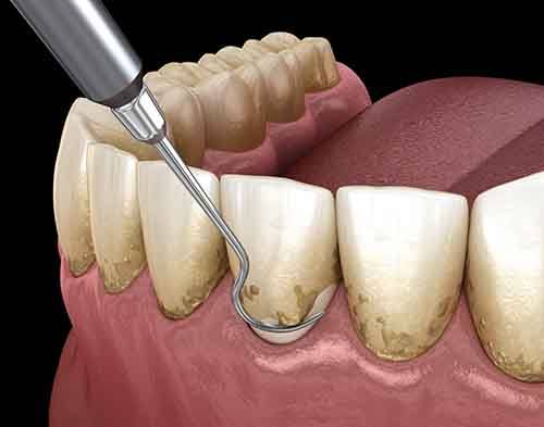 Root scaling and planing is a deep cleaning of your teeth and gum tissue