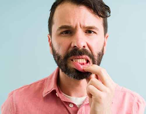 Patients with advanced periodontal disease may need root scaling and planing treatment