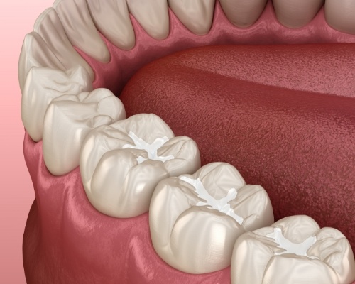 Animated row of teeth with dental sealants