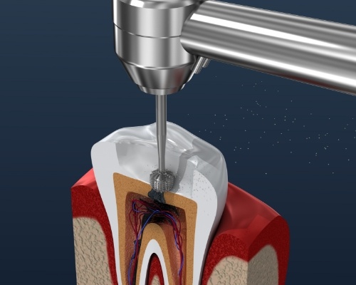 Animated dental tool performing root canal treatment in Jenks