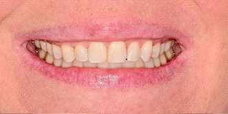 Close up of a smile with no gaps between teeth
