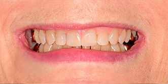 Close up of a person smiling after straightening their teeth