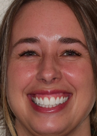 Close up of a smile with white and flawless teeth