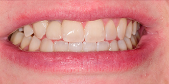 Close up of a mouth with a full set of white teeth
