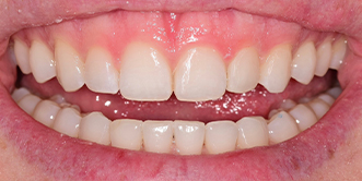 Close up of a mouth with evenly spaced teeth