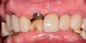 Close up of a mouth with a visible dental implant abutment