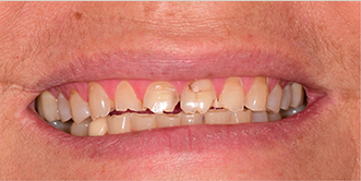 Close up of a smile with discolored and damaged teeth