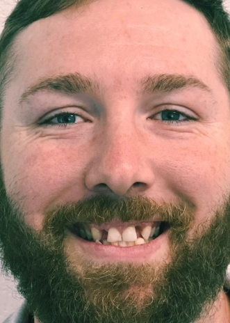 Close up of a smile with discolored and damaged teeth