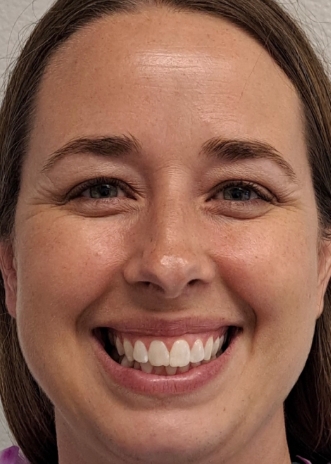 Close up of a smile with discolored and damaged teeth