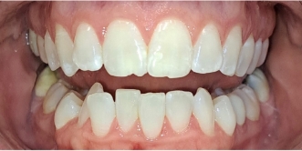 Close up of a smile with discolored and damaged teeth