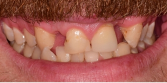 Close up of a smile with discolored and damaged teeth