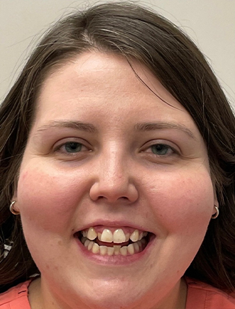 Smiling woman with crowded teeth