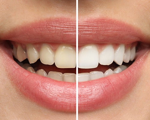 Closeup of a smile that’s half whitened to show before/after results