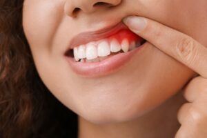 Woman pointing to red, inflamed gum.