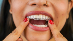 Woman putting on top Invisalign tray